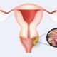 Cáncer de vagina: síntomas, causas y tratamiento
