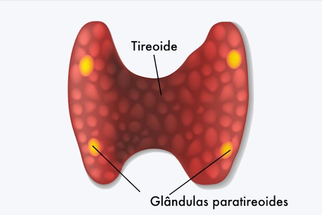 Hiperparatireoidismo: Principais Tipos, Sintomas E Tratamento - Tua Saúde