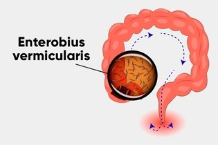 Enterobius vermicularis transmissao, Oxiuros en las heces, Hpv impfung danemark