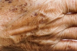 9 principais causas de manchas de pele (e como tirar)