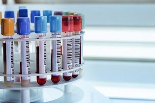 Illustrative image of the article Anemia Blood Tests: 8 Lab Tests Your Doctor May Order