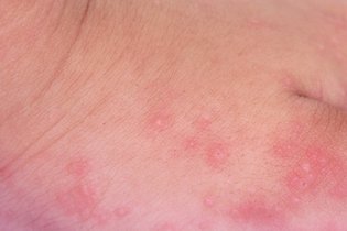 Dermatite alérgica: o que é, sintomas, causas e tratamento