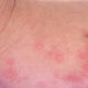 Dermatite alérgica: o que é, sintomas, causas e tratamento