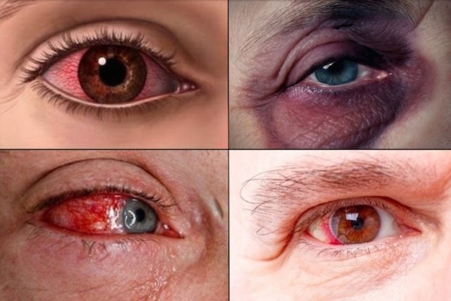 O que fazer em caso de ferimento nos olhos Tua Saúde