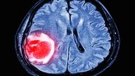 Quiste en el cerebro: qué es, síntomas y tratamiento
