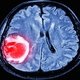 Cisto no cérebro: tipos, sintomas causas e tratamento