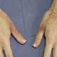 7 tipos comuns de manchas escuras na pele (e como tratar)