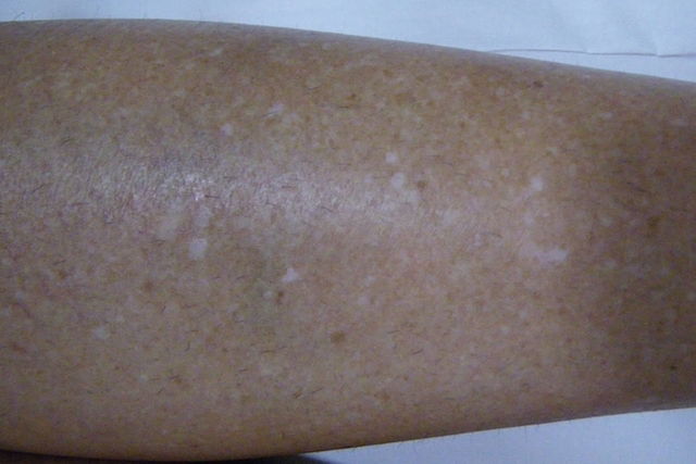 White Spots On Skin 7 Causes How To Get Rid Of Them Tua Saude