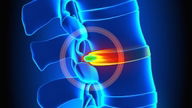 Hernia discal: tipos, síntomas y tratamiento