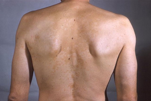 White Spots On Skin 7 Causes How To Get Rid Of Them Tua Saude