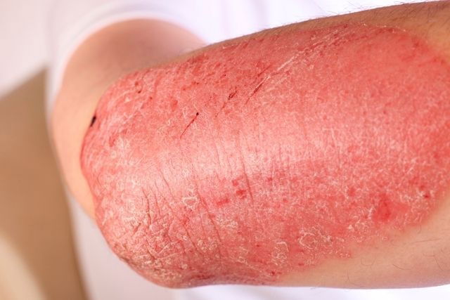 Psoriasis