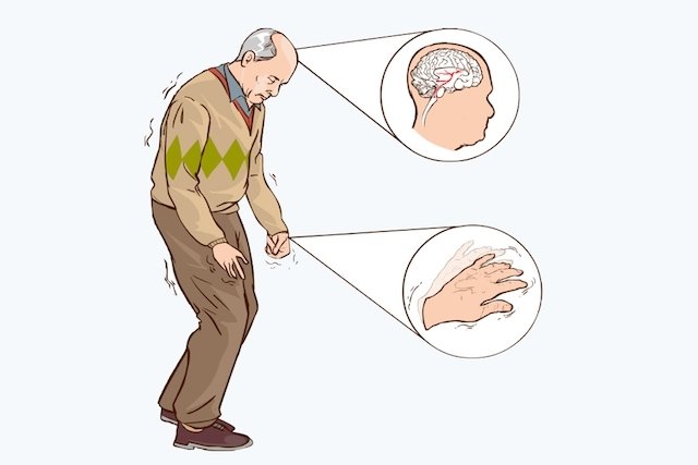 Principais sinais e sintomas do Parkinson