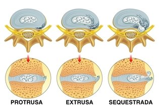 Imagem ilustrativa do artigo Hérnia de disco: o que é, tipos, sintomas e tratamento