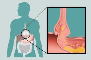 Imagem ilustrativa do artigo 11 sintomas de hérnia de hiato (e como aliviar)