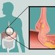 9 sintomas de hérnia de hiato (e como aliviar)