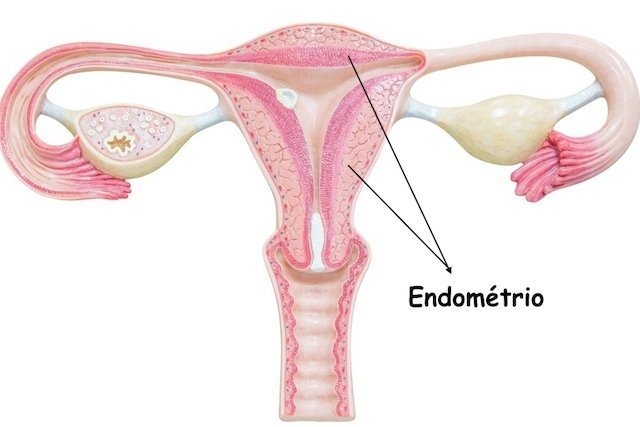 cancer endometrial tratamento)