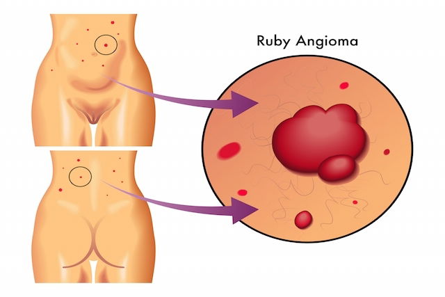 Angioma: o que é, principais tipos e tratamento - Tua Saúde