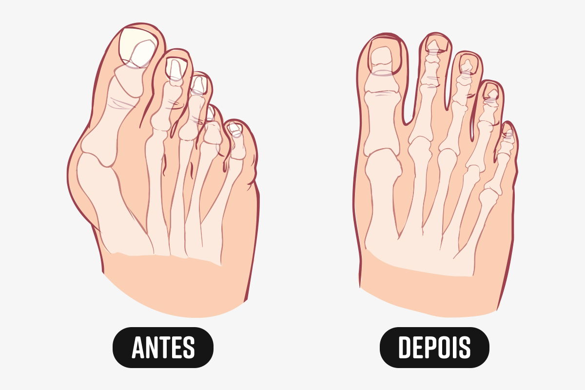 Antes e depois da cirurgia