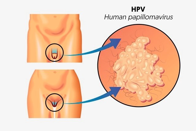Symptoms of human papillomavirus in females