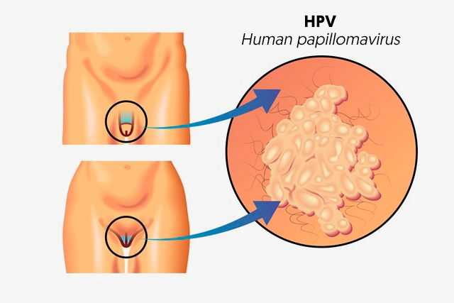 human papillomavirus infection symptoms female