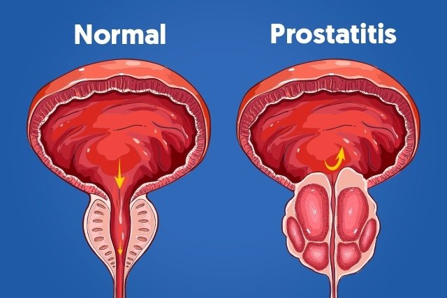 prostatitis que es