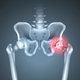 Artrosis de cadera: qué es, síntomas y tratamiento