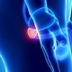 Câncer de próstata: o que é, sintomas, causas e tratamento
