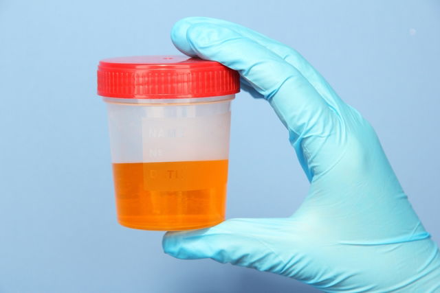 bilirubin in urine