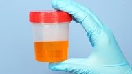 Bilirubin in Urine: Common Causes & What to Do