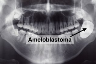 Imagem ilustrativa do artigo Ameloblastoma: o que é, sintomas, tipos e tratamento
