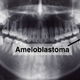 Ameloblastoma: o que é, sintomas, tipos e tratamento