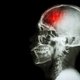 Isquemia cerebral: o que é, sintomas, causas e tratamento