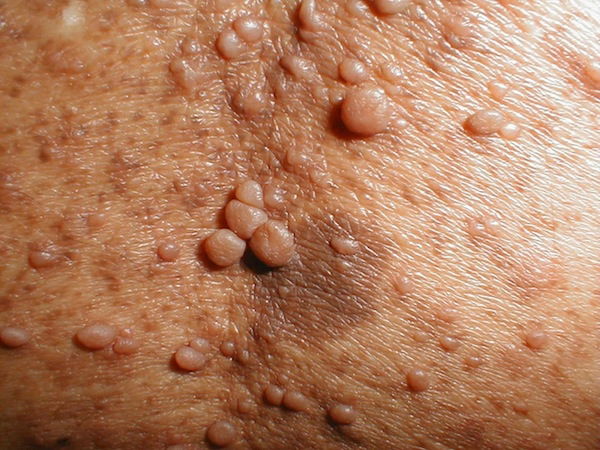 Tumores da neurofibromatose chamados de neurofibromas