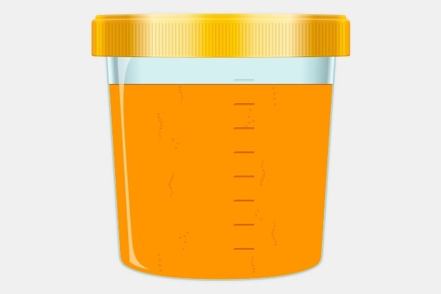 8 Doenças que podem alterar a cor da urina