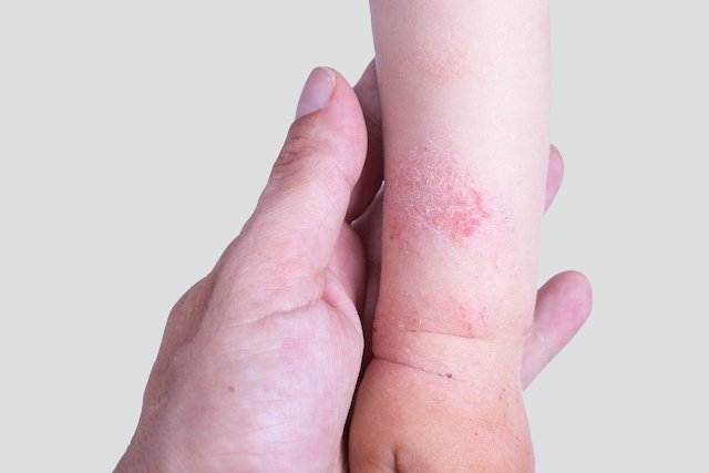 التهاب الجلد التأتبي: ما هو وأهم أعراضه وطرق علاجه