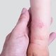Dermatite atópica: o que é, sintomas, causas e tratamento