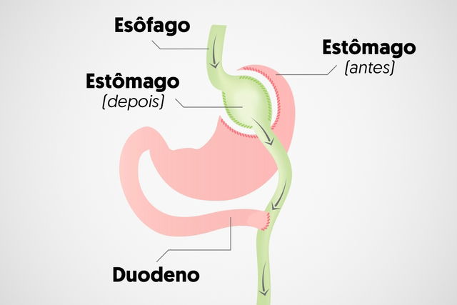 Entenda o que é e como é feita cirurgia bariátrica, procedimento