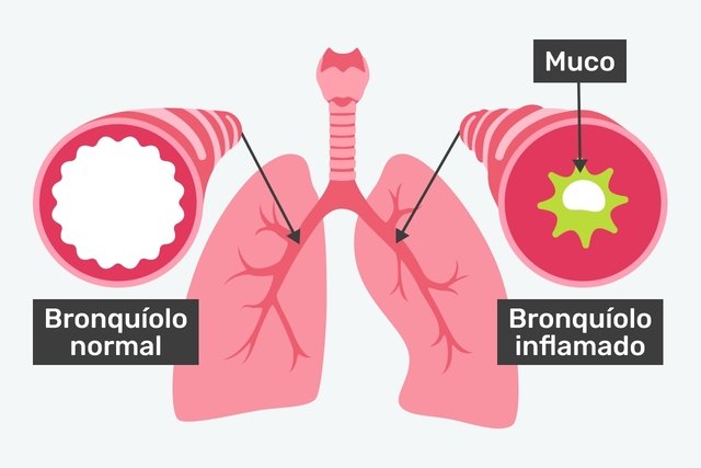 representação visual mostrando bronquíolo inflamado e com muco, e bronquíolo normal
