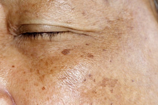 alojamiento cocaína frecuentemente Manchas oscuras en la piel: cómo identificarlas y cómo tratar - Tua Saúde