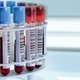 Anemia hemolítica autoinmune: qué es, síntomas y tratamiento
