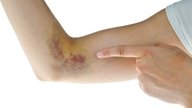 Bruise Home Remedies: 5 Methods to Get Rid of Bruising Quick