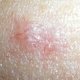 4 sinais de câncer de pele (melanoma e não-melanoma)