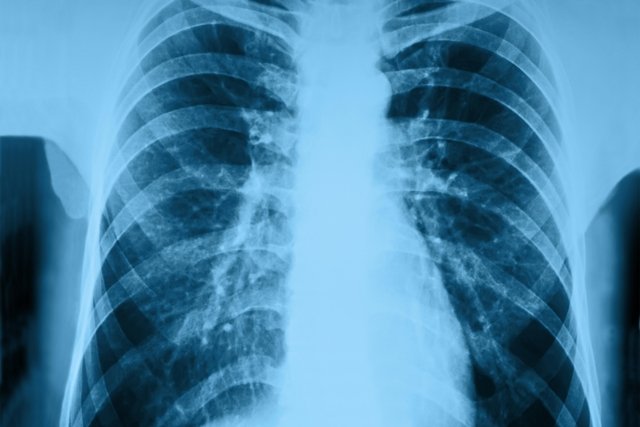 X ray of a lung with pneumonia