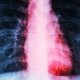 Miocarditis: qué es, síntomas y tratamiento