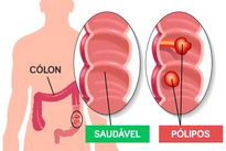 Como Tratar A Sindrome Do Intestino Irritavel Dieta Remedios E