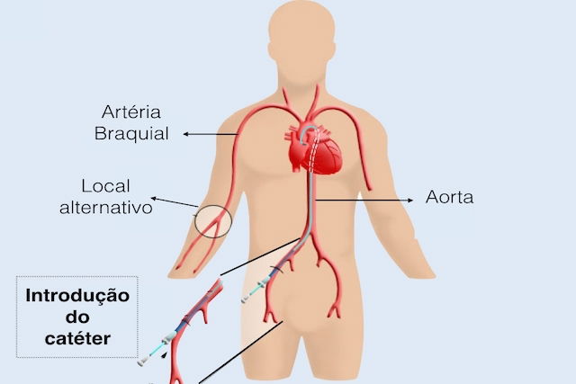  comment se fait le cathétérisme cardiaque 