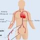 Cateterismo cardíaco: o que é, como é feito e cuidados