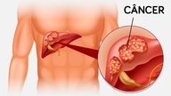 Câncer no fígado: sintomas, causas e tratamento