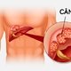 Cáncer de Hígado: síntomas, causas y tratamiento