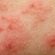 Eczema: qué es, síntomas, causas y tratamiento